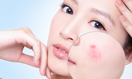 Các bước chăm sóc da mặt mụn bạn cần biết