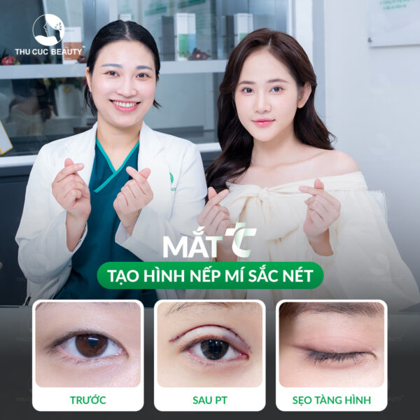 Cắt mí là dịch vụ được yêu thích tại Thu Cúc Mega Beauty Center.