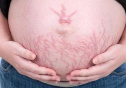 Bị rạn da bụng khi mang thai phải làm sao?