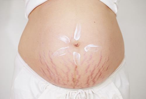 Rạn da là tình trạng thường gặp ở phụ nữ mang thai