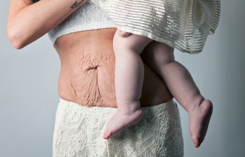 Tình trạng rạn da bụng không chỉ tồn tại trong thai kì mà còn đeo bám các mẹ trong quãng đời về sau. Vòng 2 quyến rũ ngày nào giờ chỉ là nhúm da nhăn nheo, chảy xệ…