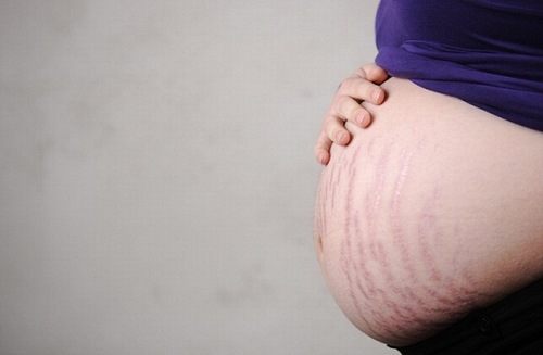 Rạn da là một trong những vấn đề về da mà hầu hết chị em trong giai đoạn mang bầu đều mắc phải