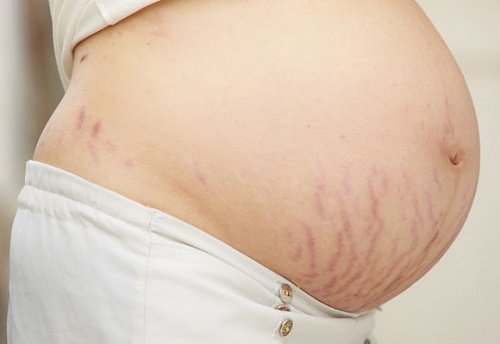 Mang thai là nguyên phổ biến gây nên tình trạng rạn da.