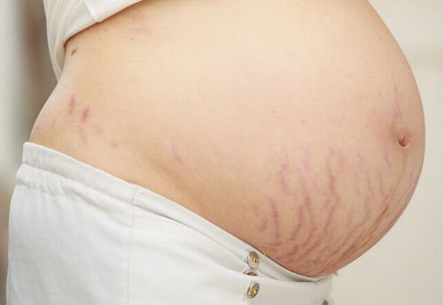 Rạn da sẽ để lại những vết hằn "xấu xí" trên cơ thể sau khi sinh