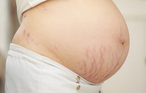 Sự phát triển của thai nhi khiến các mẹ dễ dàng bị rạn da.
