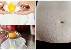 Chia sẻ cách chữa rạn da bằng lòng trắng trứng gà