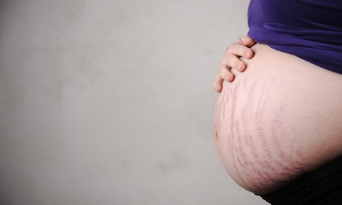Một vài nghiên cứu đã chỉ ra rằng tỉ lệ phụ nữ bị rạn da khi mang thai chiếm tới 80%. 