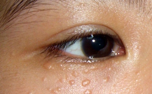 Mụn thịt ở mí mắt hay xuất hiện quanh mắt là tình trạng khá phổ biến.