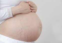Mẹ bầu bị rạn da khi mang thai xuất hiện khi nào?