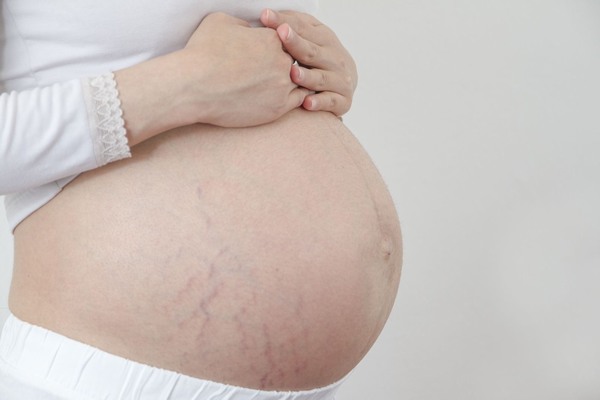 Trong quá trình mang thai, cân nặng tăng lên là điều tất yếu và rạn da cũng là một trong những vấn đề rất khó tránh khỏi. 