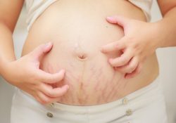 Cách giảm mỡ bụng, rạn da sau sinh