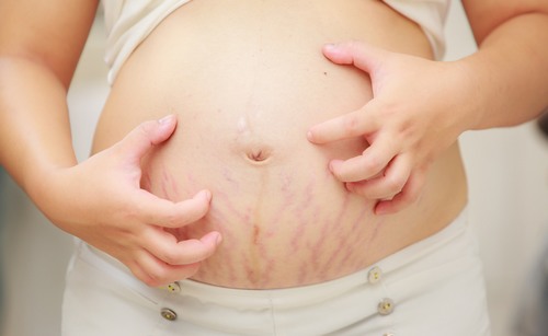 Mỡ bụng và rạn da là những khuyết điểm chị em thường gặp sau khi sinh