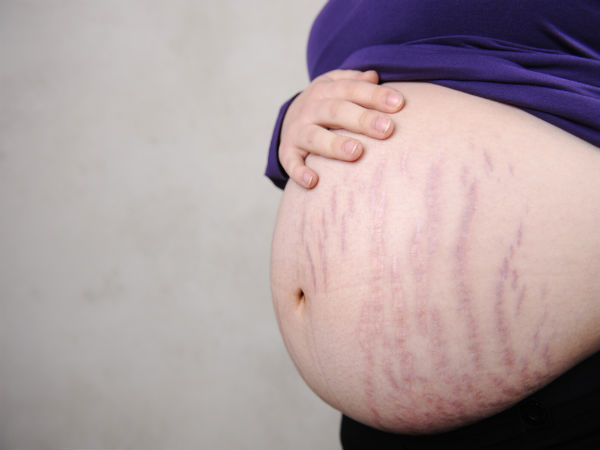 Sư gia tăng kích thước của em bé trong quá trình mang thai khiến tổ chức mô, da không kịp giãn nở, hình thành ra các vết nứt, vết rạn, ảnh hưởng nghiêm trọng tới thẩm mỹ