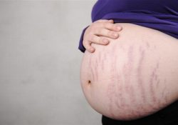 Làm thế nào để chống rạn da khi mang thai?
