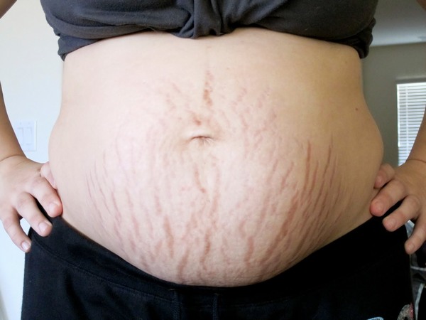 Nhiều chị em mang thai lần đầu khi thấy trên da xuất hiện các vết rạn rất lo lắng. 