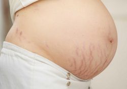 Tại sao xuất hiện rạn da ở phụ nữ mang bầu?