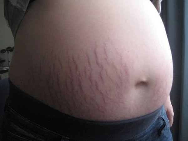 Rạn da thường xảy ra từ tháng thứ 4 của thai kì, khi thai nhi phát triển mạnh và cân nặng của mẹ bầu của tăng lên.