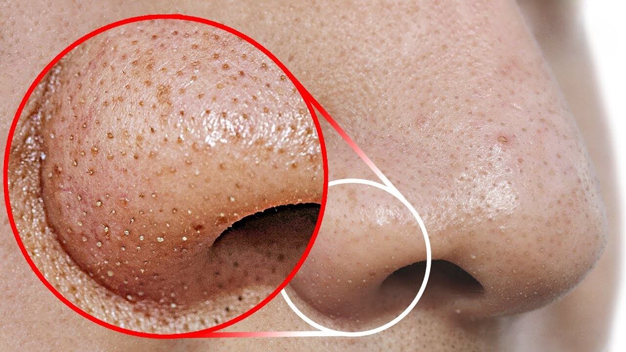 Dâu tây trị mụn đầu đen hiệu quả giúp làm sạch da, lấy đi các tế bào chết, loại bỏ nguyên nhân gây mụn