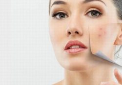 Bật mí cách chăm sóc da nhờn bị mụn cực hiệu quả
