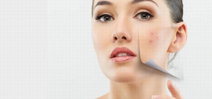 Cách chăm sóc da nhờn bị mụn cực hiệu quả