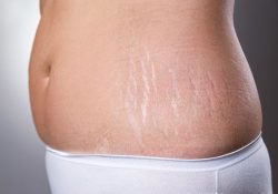 Làm sao để hết rạn da sau khi sinh?