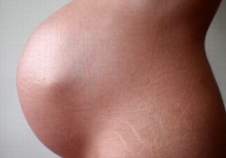 Rạn da khi mang thai – Những điều cần biết