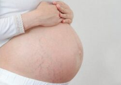 Rạn da – Vấn đề cần quan tâm khi mang thai lần đầu
