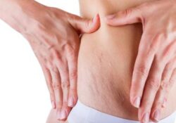 Nguyên nhân rạn da bụng khi mang thai và cách khắc phục hiệu quả